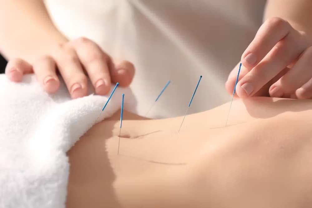 Fertility Acupuncture sammilana servicee